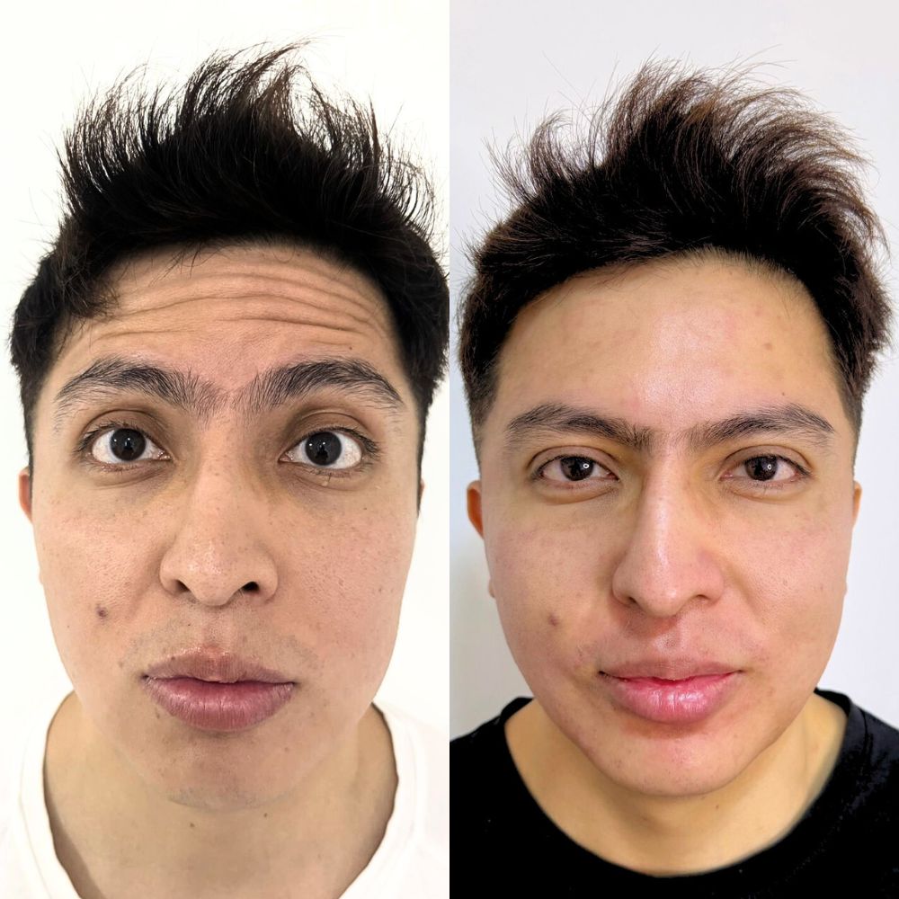 Botox